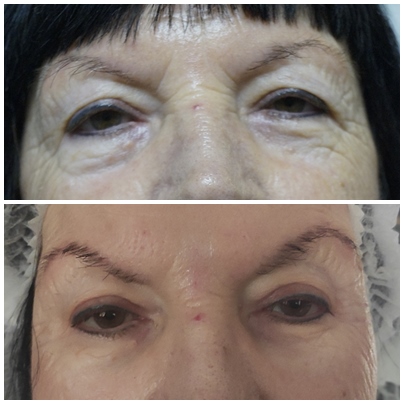 terapia, dolina łez, botoks, botox, zmarszczki, wygładzanie zmarszczek, biorewitalizacja, rewitalizacja, naturalny efekt, gładka skóra, kwas hialuronowy, wypełniacz, wypełniacze, wypełnianie zmarszczek, bruzdy, zabieg 70+, metamorfoza