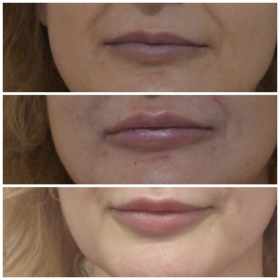 modelowanie ust, powiększanie ust, konturowanie ust, naturalny efekt, kwas hialuronowy, wypełniacz, konturowanie, wypełnianie, duże usta, kuszące usta, kwas hialuronowy, wypełniacze