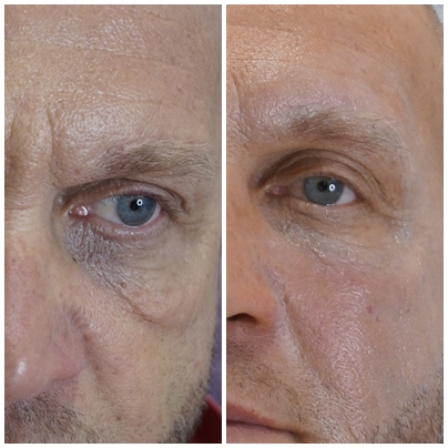 dolina łez, odmładzanie środkowej części twarzy, worki pod oczami, likwidacja worków pod oczami, zmęczone oczy, wolumetria, zabieg dla mężczyzn, wypełniacz, kwas hialuronowy