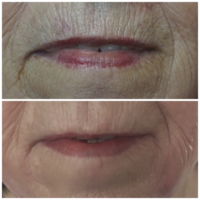 stymulatory tkankowe, biorewitalizacja, rewitalizacja, rewitalizacja skóry, odmładzanie, naturalny, zmarszczki palacza, odżywianie skóry, odmładzanie, gładka skóra, jędrna skóra, zabieg 70+