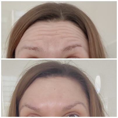 botoks, botox, wygładzanie zmarszczek, zmarszczki, spłycanie zmarszczek, gładkie czoło