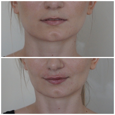 terapia, terapia autorska, zabieg autorski, holistyczny, powiększanie ust, modelowanie ust, wypełnianie ust, kwas hialuronowy, wypełniacz, wypełniacze, konturowanie ust, naturalny efekt, naturalne, kąciki ust, lifting ust