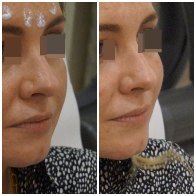 woluemtria, modelowanie, modelowanie kości policzkowych, kości policzkowe, wypełnianie, wypełnianie kości, konturowanie, kontur, kontur twarzy, owal twarzy, owal, lifting, kwas hialuronowy, wypełniacz, wypełniacze