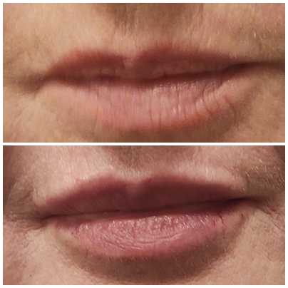 terapia, terapia autorska, zabieg autorski, holistyczny, powiększanie ust, modelowanie ust, wypełnianie ust, kwas hialuronowy, wypełniacz, wypełniacze, konturowanie ust, naturalny efekt, naturalne